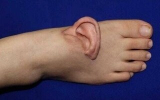 Chinese Worker Undergoes Ear Transplant to Foot After Workplace Accident