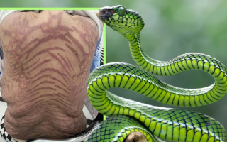 Woman in China Treated with 'Traditional Medicine' Develops Snake-Skin-Like Spots