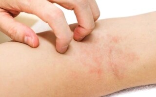 Plant Compound 'Saponin A' Promising for Neurodermatitis Treatment