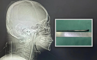 Man in China Has Chopstick Stuck in Throat for Eight Years Removed