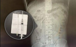 Man in China finds thermometer he swallowed 20 years ago